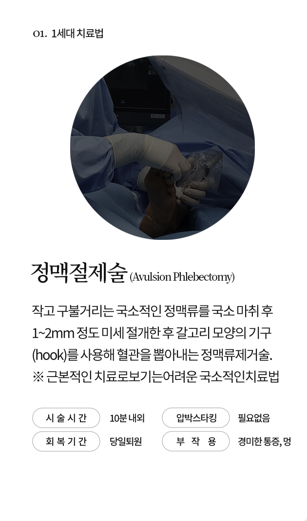 정맥절제술