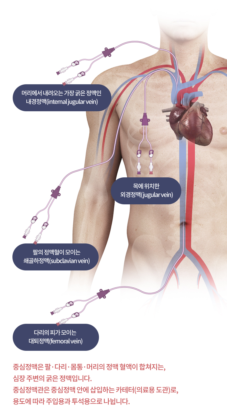 중심정맥관이란