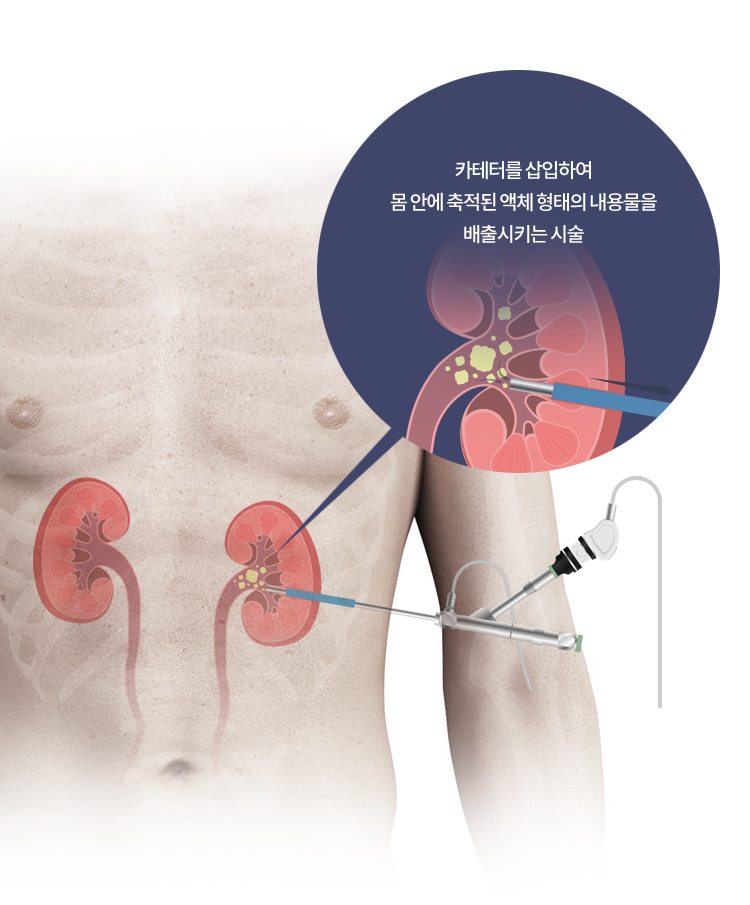 경피적 카테터 배액술이란?