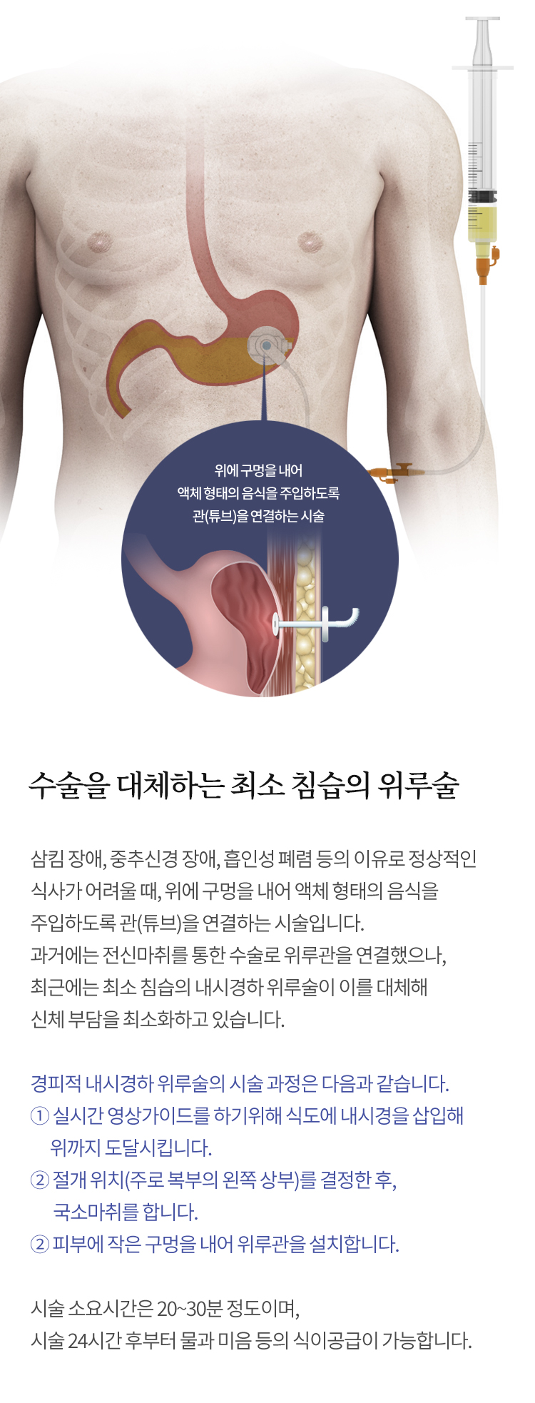 경피적 내시경하 위루술이란?