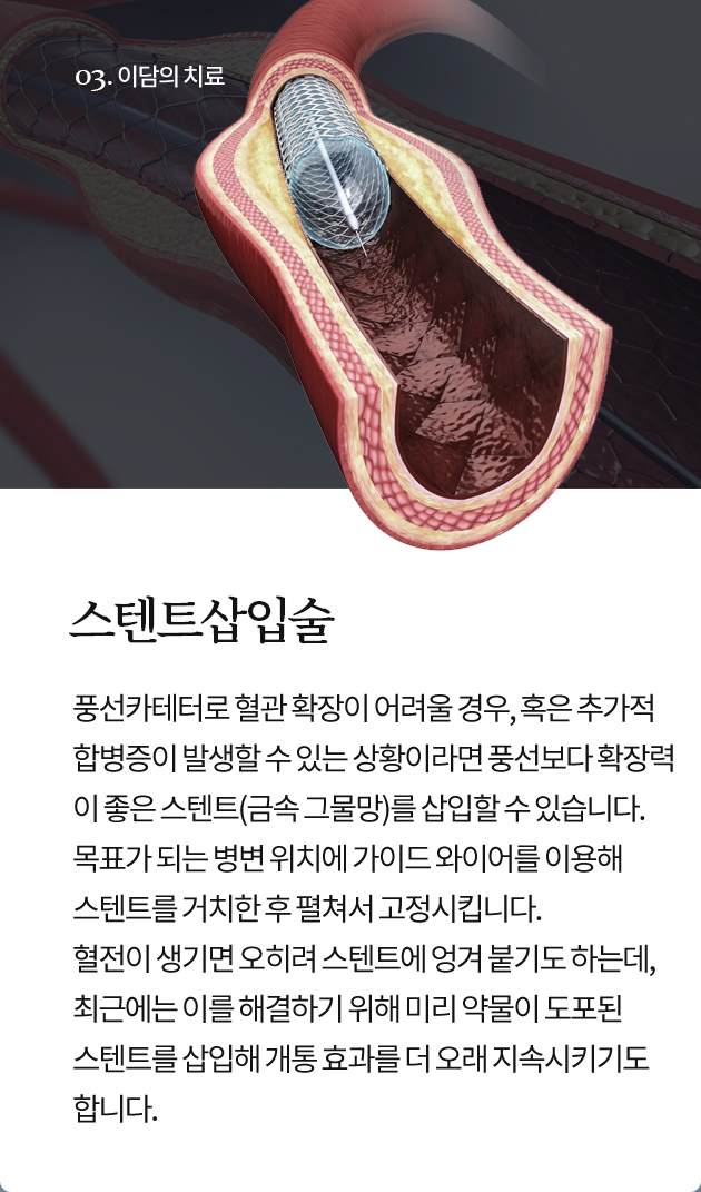 스텐트삽입술