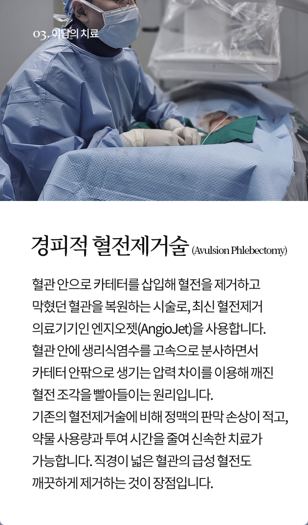 경피적 혈전제거술 (Avulsion Phlebectomy)