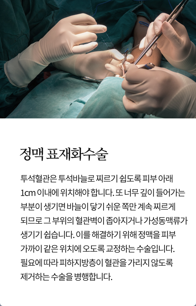 정맥 표재화수술