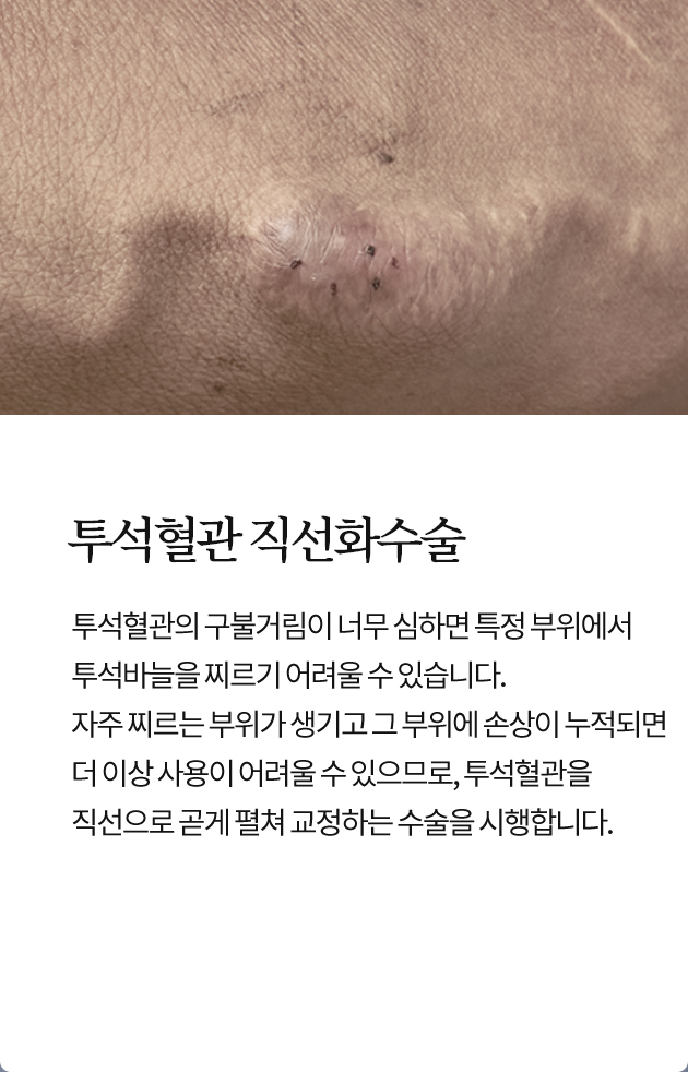 투석혈관 직선화수술