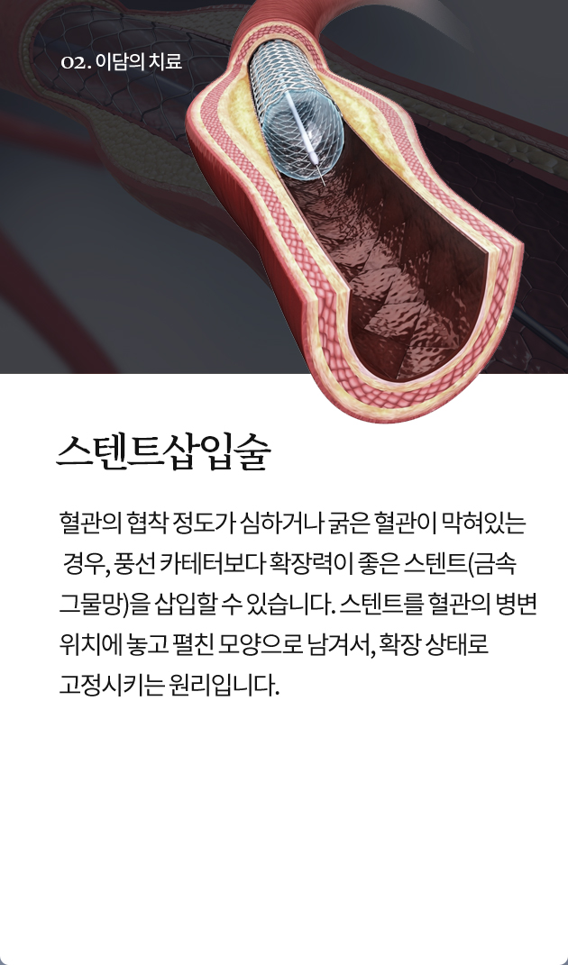 스텐트삽입술