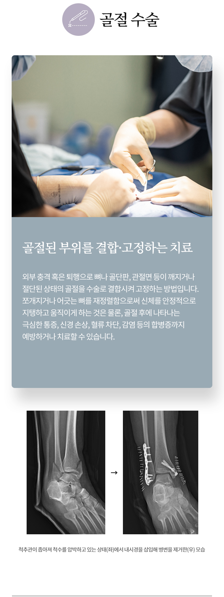 골절 수술