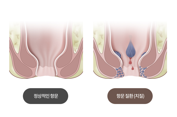 원인